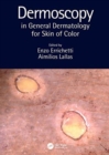 Dermoscopy in General Dermatology for Skin of Color - Book