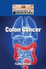 Colon Cancer - eBook