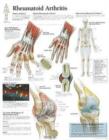 Rheumatoid Arthritis Laminated Poster - Book