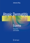 Atopic Dermatitis : Eczema - eBook