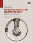 Adhesive cementation on natural teeth - Materials and techniques - Book