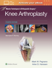 Master Techniques in Orthopedic Surgery: Knee Arthroplasty, Hardback Book Master Techniques in Orthopedic Surgery: Knee Arthroplasty, Hardback Book