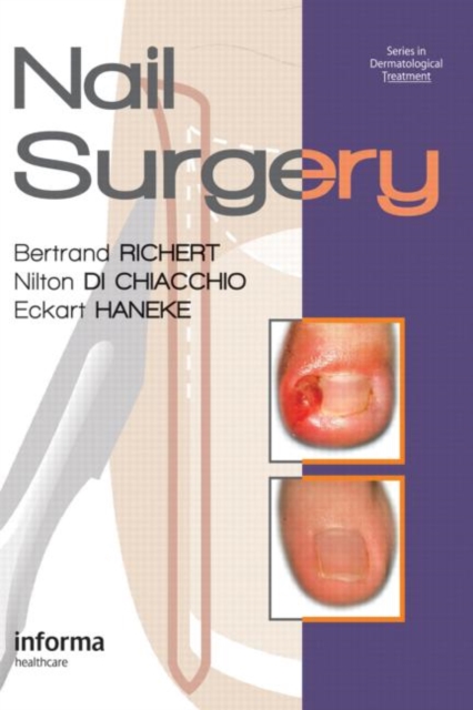 Nail Surgery, Hardback Book
