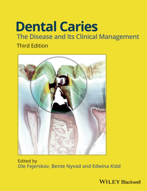 Dental Caries : The Disease and its Clinical Management, Hardback Book