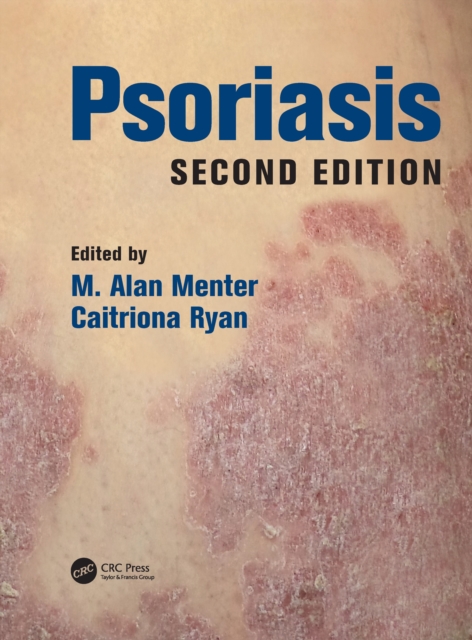 Psoriasis, EPUB eBook