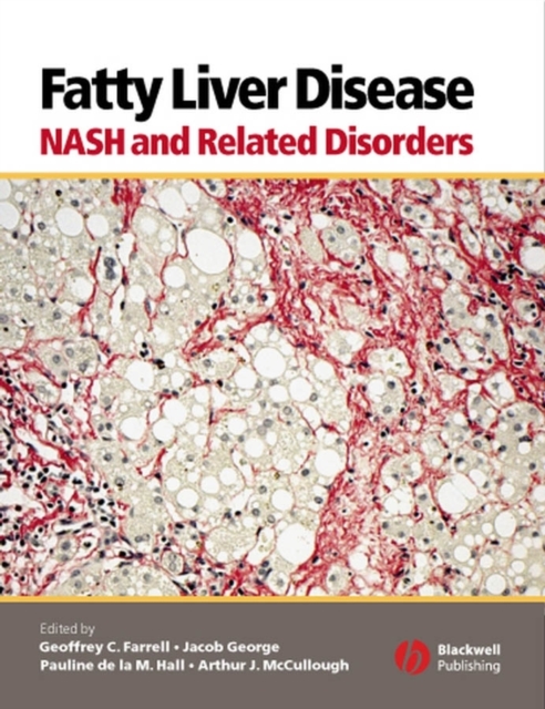 Fatty Liver Disease : NASH and Related Disorders, PDF eBook