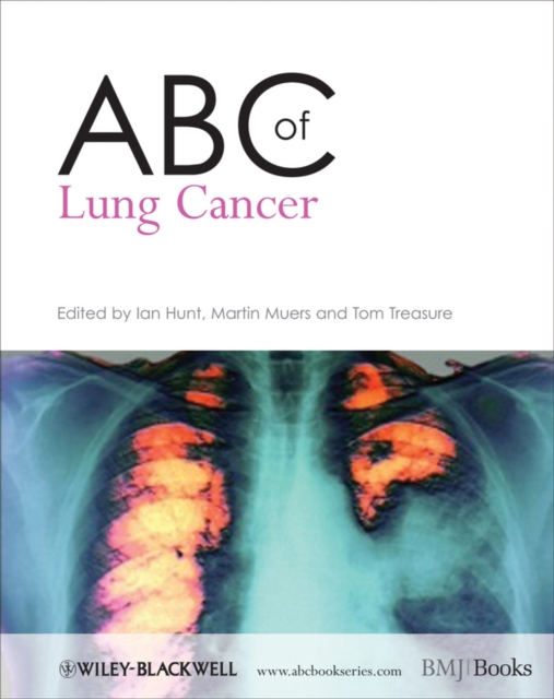 ABC of Lung Cancer, Paperback / softback Book