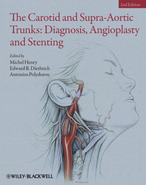 The Carotid and Supra-Aortic Trunks : Diagnosis, Angioplasty and Stenting, EPUB eBook