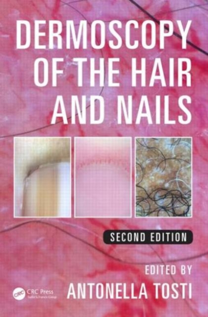 Dermoscopy of the Hair and Nails, Hardback Book
