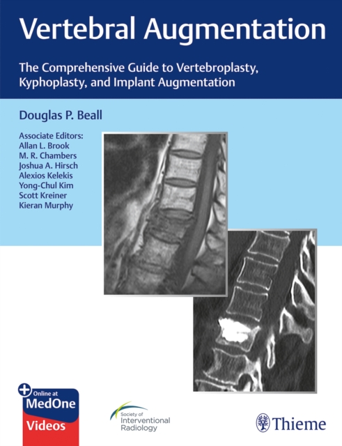 Vertebral Augmentation : The Comprehensive Guide to Vertebroplasty, Kyphoplasty, and Implant Augmentation, Multiple-component retail product, part(s) enclose Book