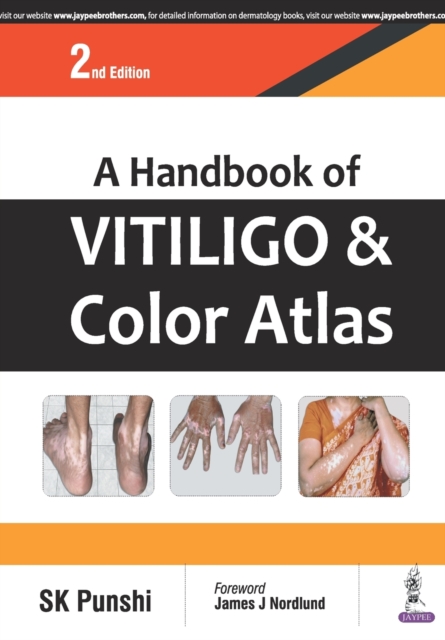 A Handbook of Vitiligo & Color Atlas, Paperback / softback Book A Handbook of Vitiligo & Color Atlas, Paperback / softback Book