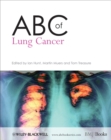 ABC of Lung Cancer - Book