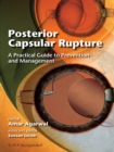 Posterior Capsular Rupture : A Practical Guide to Prevention and Management - eBook