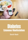 Diabetes : Cutaneous Manifestations - eBook