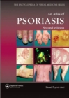 An Atlas of Psoriasis, Second Edition - Book