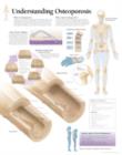 Understanding Osteoporosis Paper Poster - Book