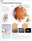 Understanding Glaucoma Laminated Poster - Book