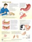 Peptic Ulcer Chart - Book
