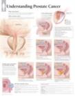 Understanding Prostate Cancer Laminated Poster - Book