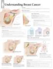 Understanding Breast Cancer Laminated Poster - Book