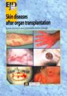 Skin Diseases After Organ Transplantation - Book