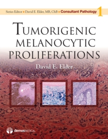Tumorigenic Melanocytic Proliferations