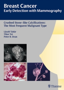 Breast Cancer: Early Detection with Mammography : Crushed Stone-like Calcifications: The Most Frequent Malignant Type