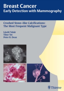 Breast Cancer: Early Detection with Mammography : Crushed Stone-like Calcifications: The Most Frequent Malignant Type