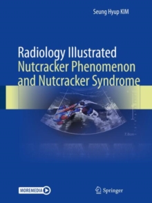 Radiology Illustrated: Nutcracker Phenomenon and Nutcracker Syndrome