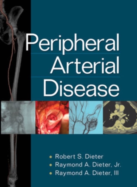 Peripheral Arterial Disease, Hardback Book