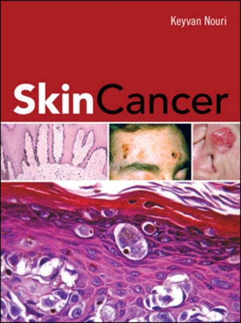 Skin Cancer, EPUB eBook