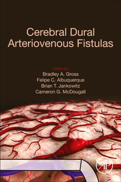 Cerebral Dural Arteriovenous Fistulas, Paperback / softback Book