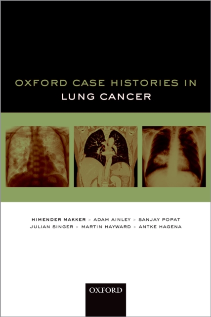 Oxford Case Histories in Lung Cancer, EPUB eBook