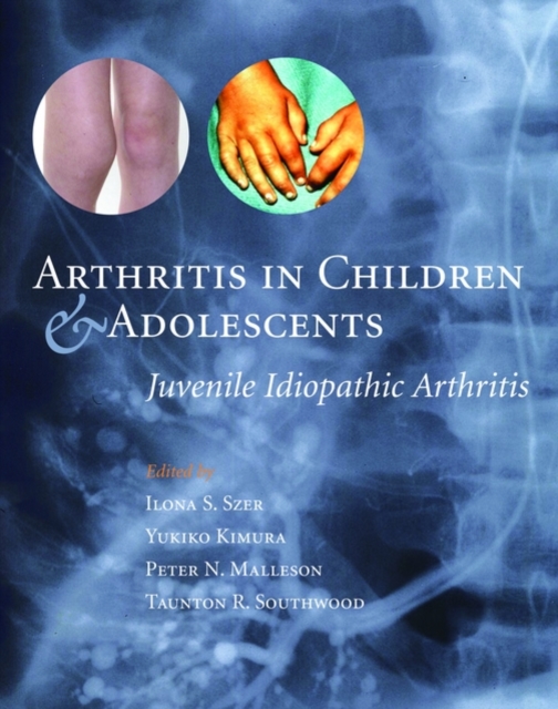 Arthritis in Children and Adolescents : Juvenile Idiopathic Arthritis, Hardback Book