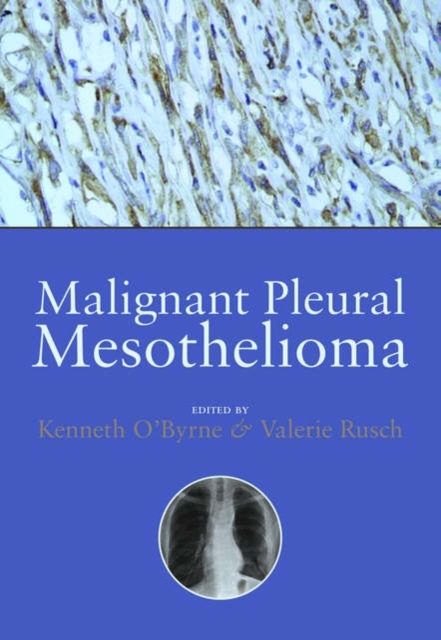 Malignant Pleural Mesothelioma, Hardback Book