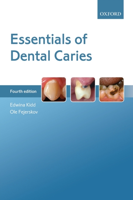 Essentials of Dental Caries, Paperback / softback Book