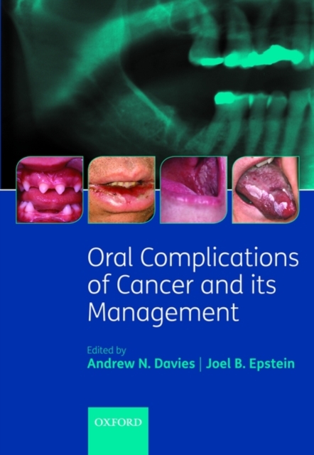 Oral Complications of Cancer and its Management, Hardback Book