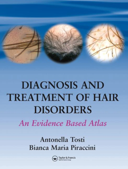 Diagnosis and Treatment of Hair Disorders : An Evidence-Based Atlas, PDF eBook