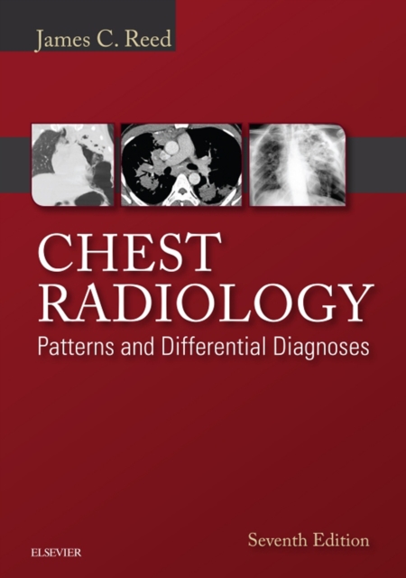 Chest Radiology: Patterns and Differential Diagnoses E-Book : Patterns and Differential Diagnoses, EPUB eBook