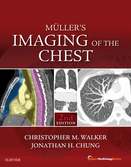Muller's Imaging of the Chest E-Book : Expert Radiology Series, EPUB eBook