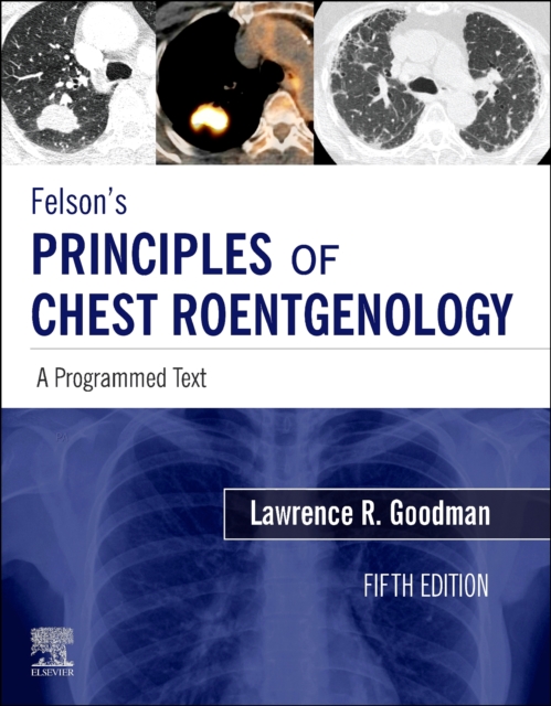 Felson's Principles of Chest Roentgenology E-Book : Felson's Principles of Chest Roentgenology E-Book, EPUB eBook