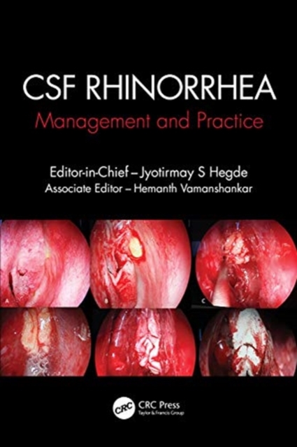 CSF Rhinorrhoea : Management and Practice, Paperback / softback Book