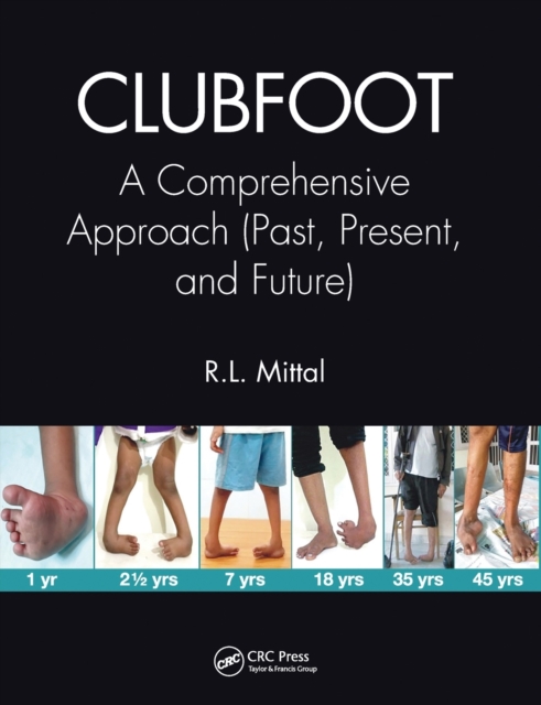 Clubfoot : A Comprehensive Approach (Past, Present, and Future), Paperback / softback Book