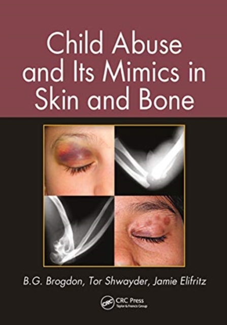 Child Abuse and its Mimics in Skin and Bone, Paperback / softback Book