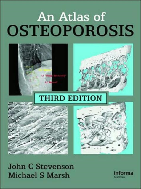 An Atlas of Osteoporosis, Hardback Book