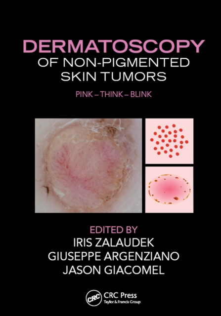 Dermatoscopy of Non-Pigmented Skin Tumors : Pink - Think - Blink, EPUB eBook