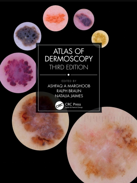 Atlas of Dermoscopy : Third Edition, PDF eBook