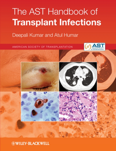 The AST Handbook of Transplant Infections, Paperback / softback Book