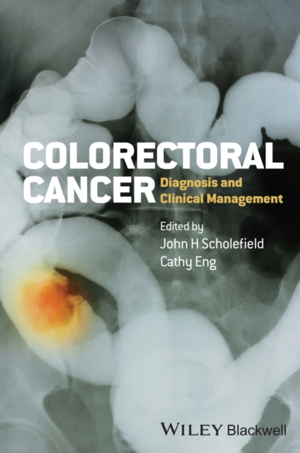 Colorectal Cancer : Diagnosis and Clinical Management, Hardback Book