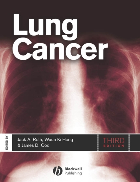 Lung Cancer, PDF eBook